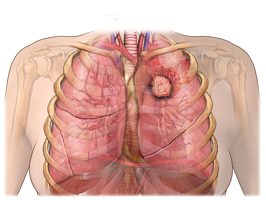 Lung Carcinoid Tumors Facts City Of Hope California 9578